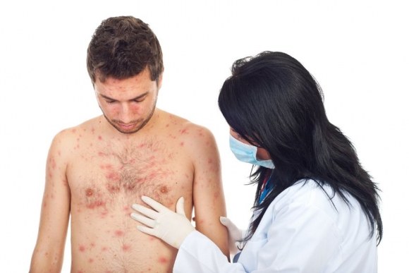 Suggerimento 1: come appare il morbillo?